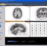 Philips und das Universitätsklinikum Hamburg-Eppendorf testen das erste Softwaretool für die automatische Auswertung von MRT- und PET-Bildern bei der Diagnose von neurodegenerativen Erkrankungen